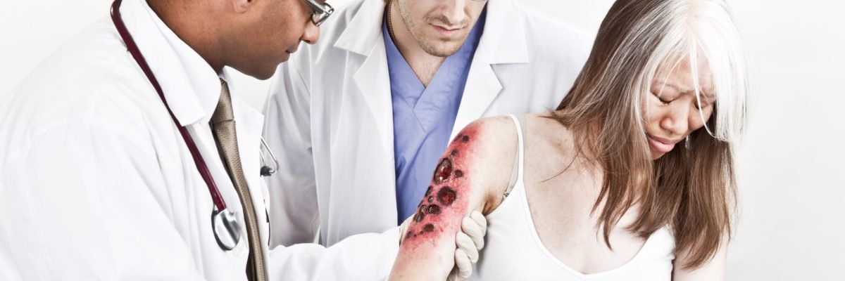 *THIS IS NOT REAL - SPECIAL EFFECTS MAKE UP* Doctors examining Third Degree Charred Flame Burn to woman's upper arm.